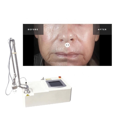 دستگاه لیزر اسکار جراحی آکنه فرکشنال 15w Co2 قابل حمل